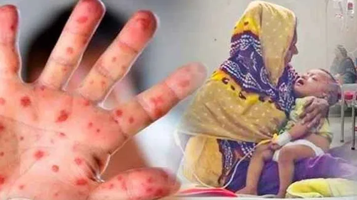 ২৪ ঘণ্টায় হামের উপসর্গে ৩ মৃত্যু, আক্রান্ত ও হাসপাতালে ভর্তি বাড়ছে