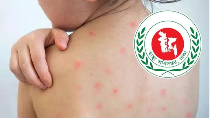 দেশে হামের উপসর্গে মৃত্যু ছাড়াল ১২০০